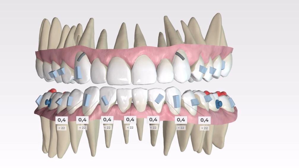 SPARK aligners beugel orthodontie