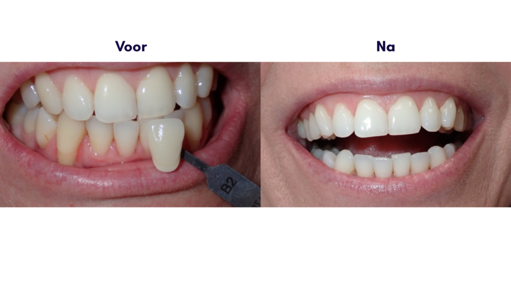 Voor