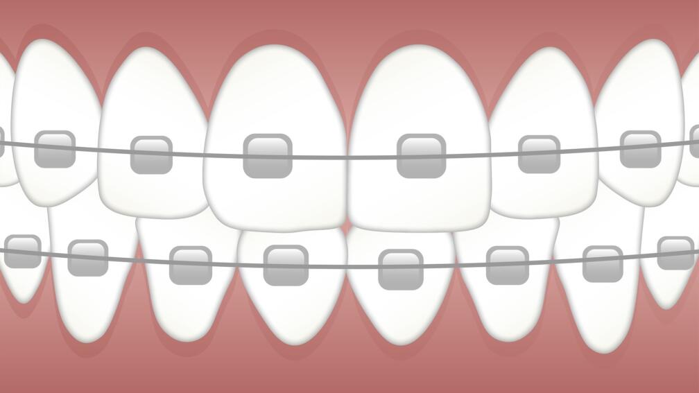Braces 3597591 1920