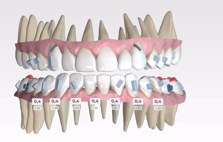 SPARK aligners beugel orthodontie